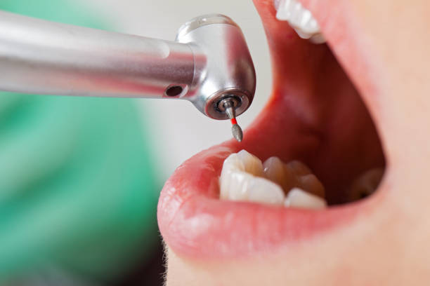 Best Emergency Dental Extractions in Huron, CA